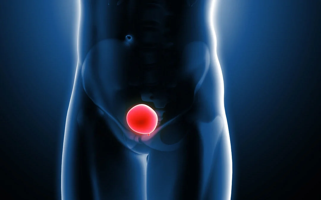 Nova terapia para câncer de bexiga aumenta em 34% a chance de cura
