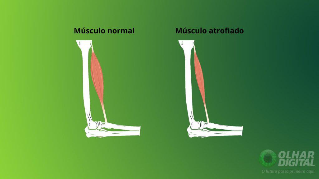 Atrofia e hipertrofia muscular: entenda como esses processos impactam sua saúde