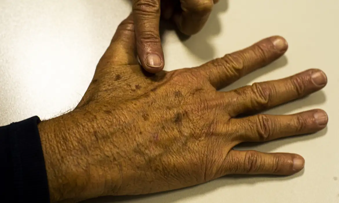 Hospital das Clínicas oferece atendimento gratuito para detecção do câncer de pele