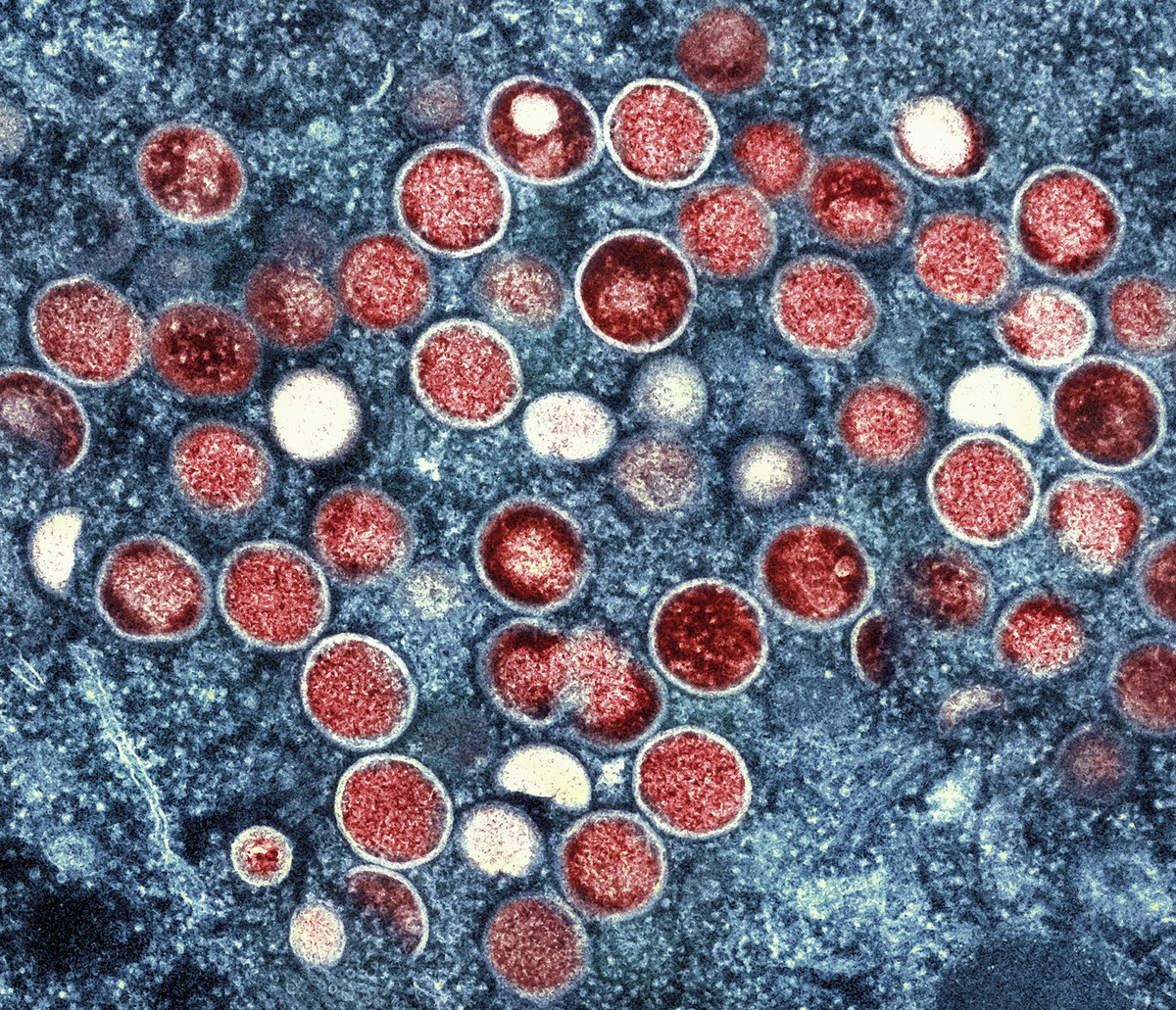 China confirma primeiro surto doméstico da nova variante de mpox | Mundo