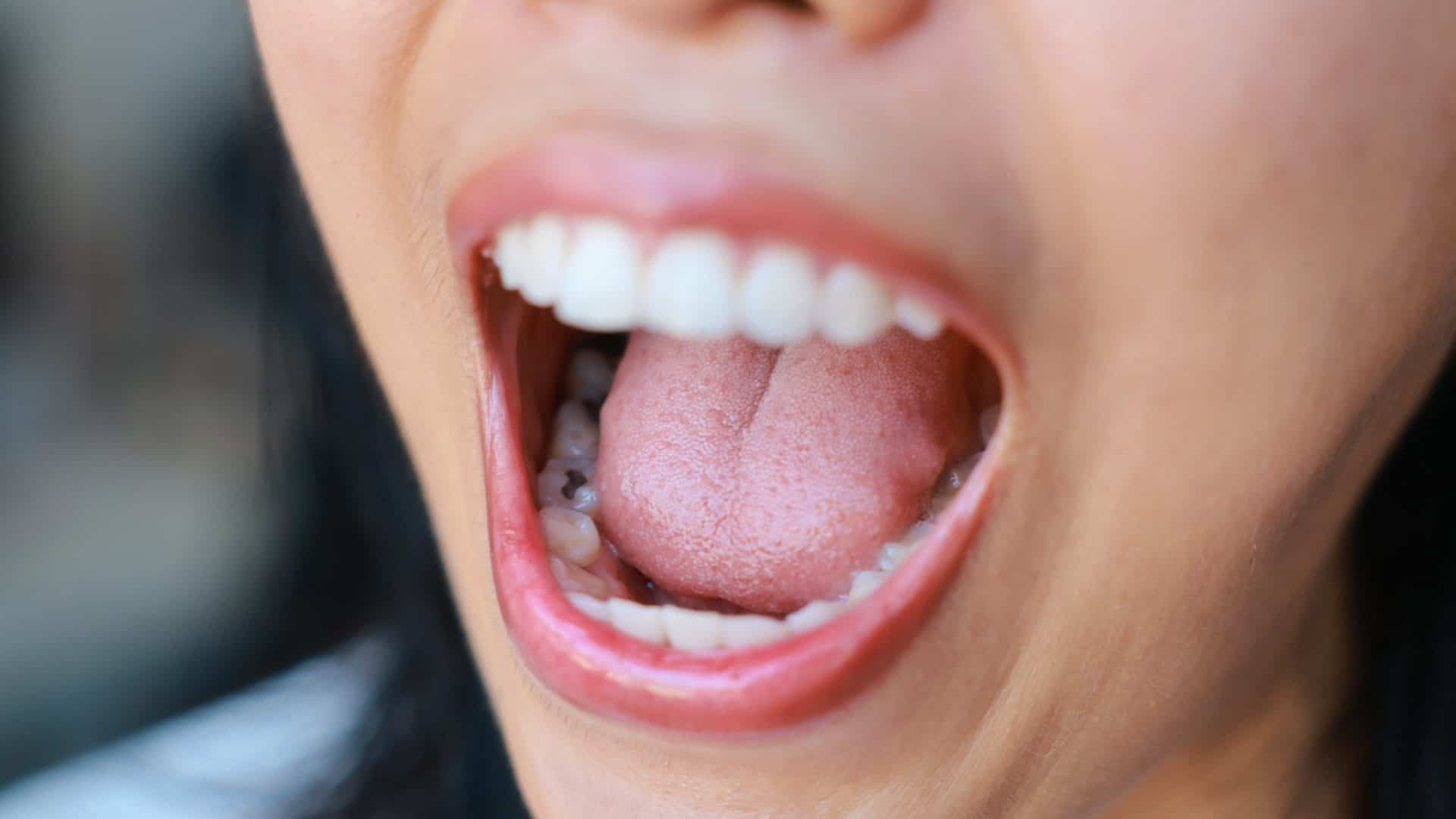 Cigarro eletrônico aumenta risco de cárie e altera os dentes