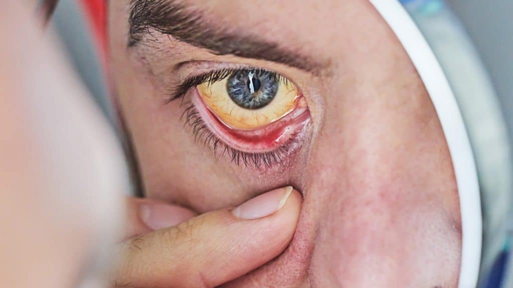 Icterícia: o que é, quais as causas e quando pode ser um sinal de alerta