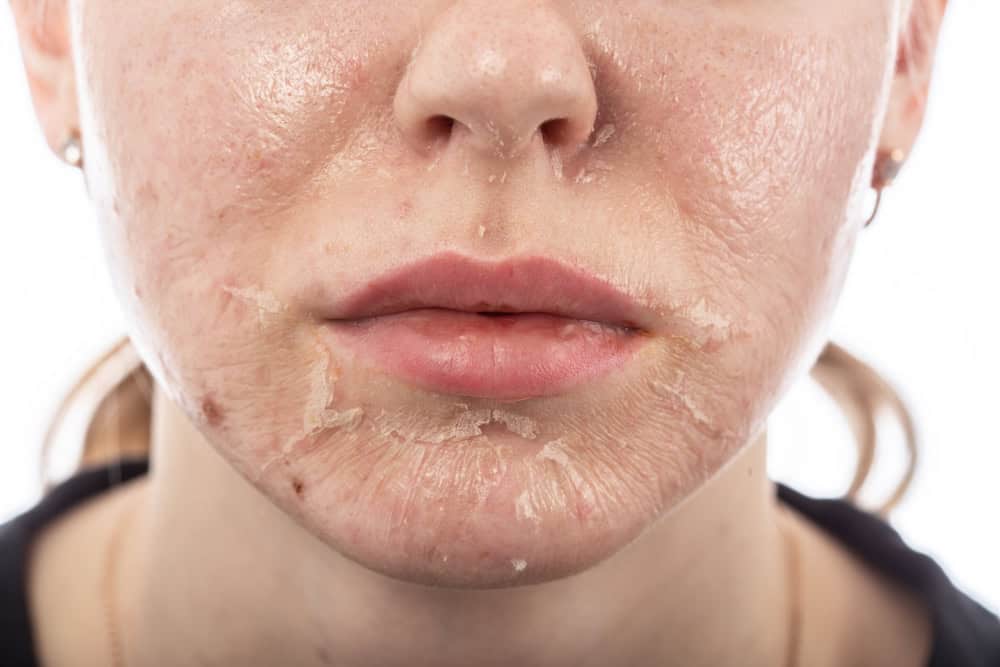 Peeling de fenol: a beleza que custa caro