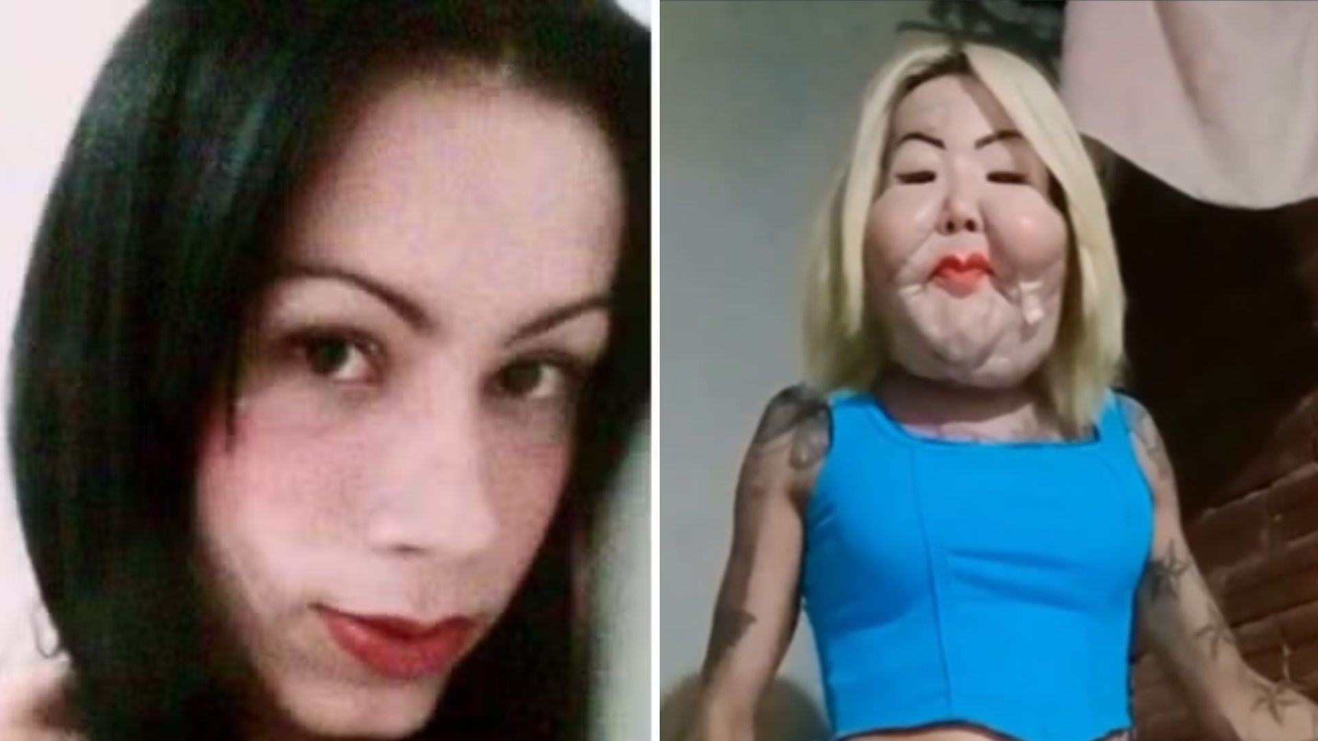Juju do Pix mostra como está seu rosto 50 dias após cirurgia para retirar óleo mineral; ve