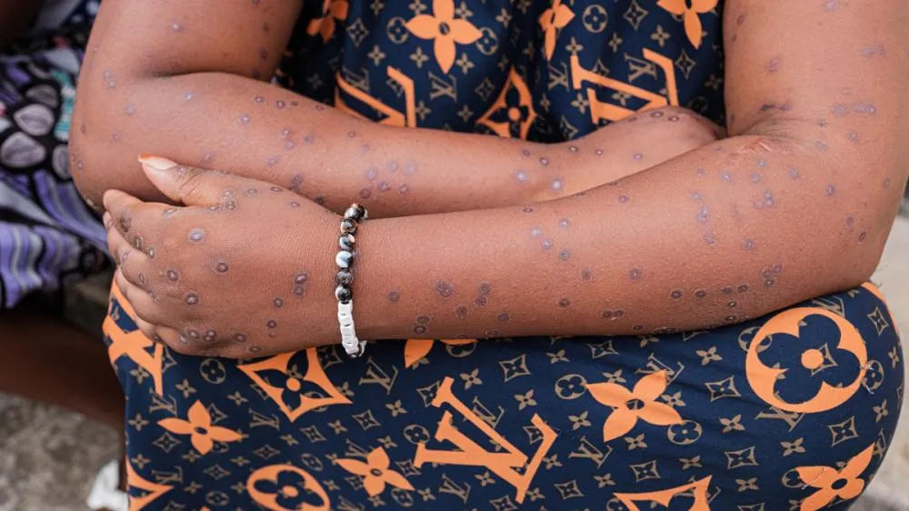 Mpox no Ceará: Saiba Como Proteger-Se Contra a Doença Infecciosa