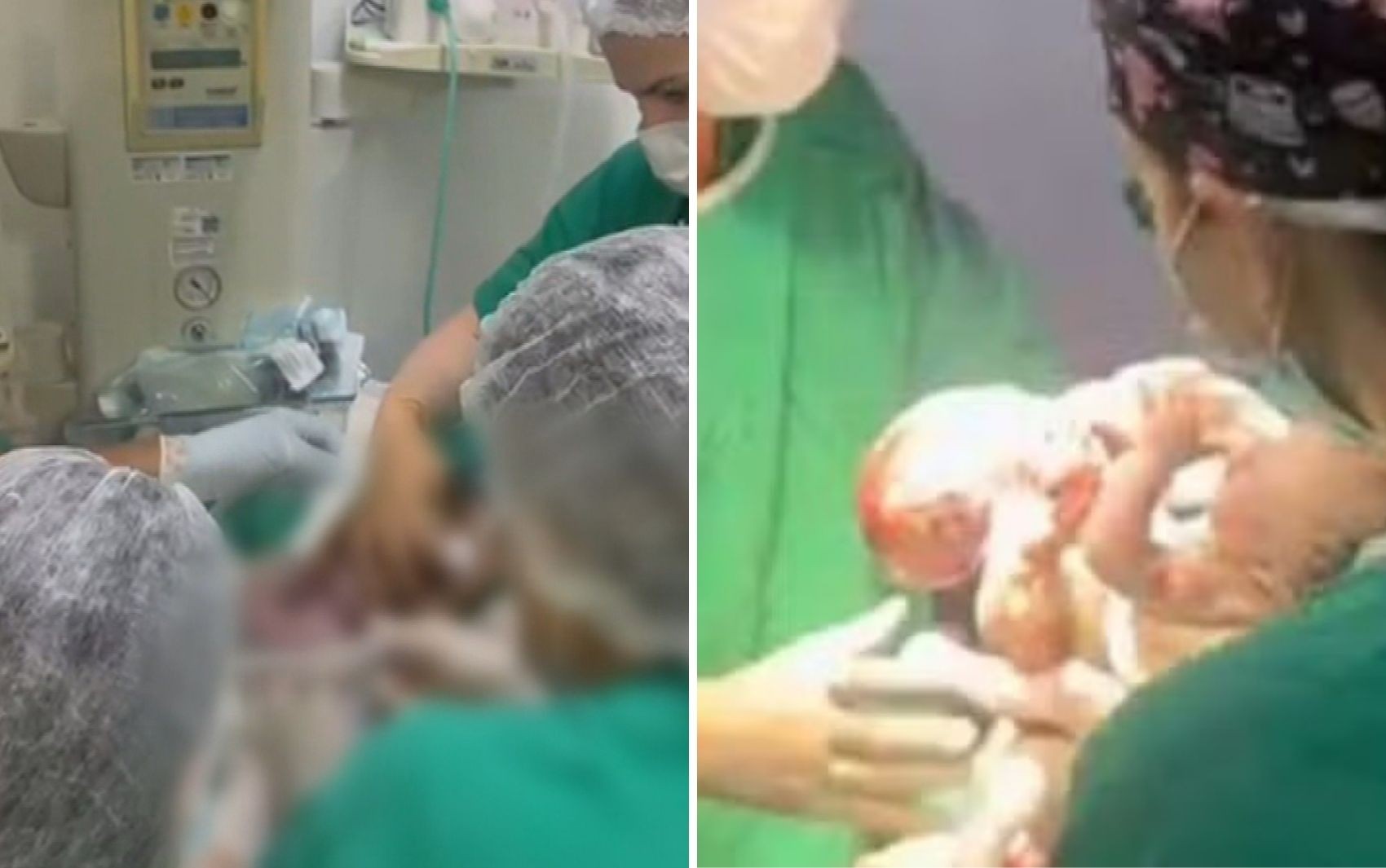 Siameses do MT nascidos pelo quadril são um caso raro, diz médico: ‘Mais complexo da minha